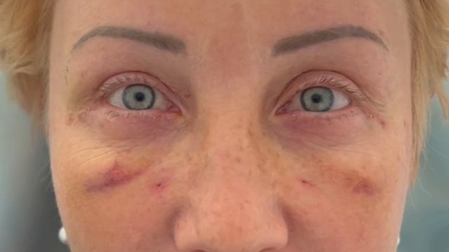 Лобно-височный лифтинг, нижняя блефаропластика, односторонняя верхняя блефаропластика