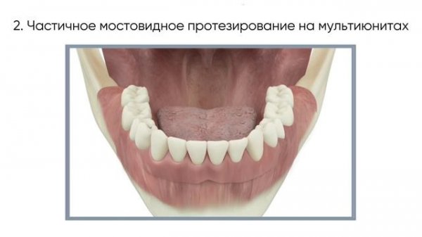 Виды протезирования на мультиюнитах