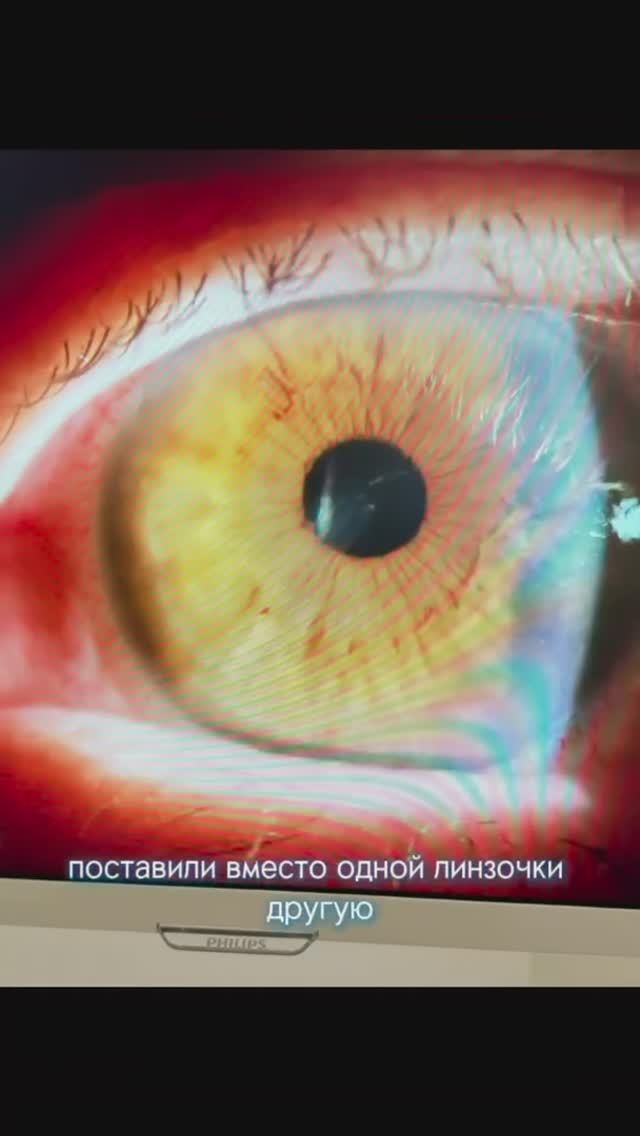 Замена ИОЛ у пациентки на новую. Первый день - результат уже хороший смотреть онлайн