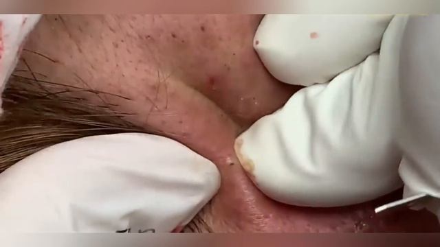 Выдавливание прыщей, угрей, черных точек и камедонов #166 смотреть онлайн