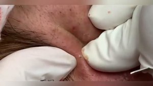 Выдавливание прыщей, угрей, черных точек и камедонов #166