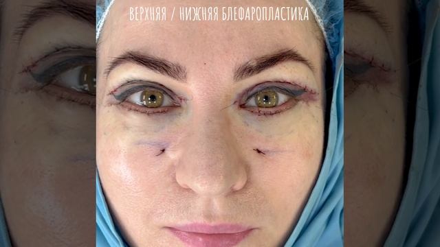 Операция верхняя — нижняя блефаропластика