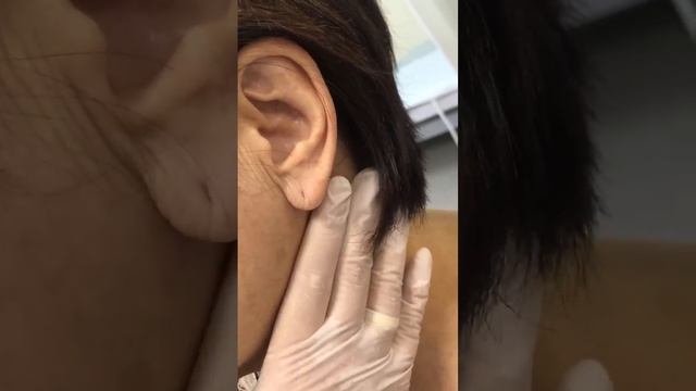 Особенности лимфатического массажа, после операций в области шеи. смотреть онлайн