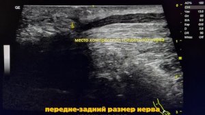 Мгновенное облегчение боли при карпальном туннельном синдроме