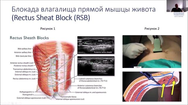 Региональная анестезия под УЗ-навигацией. Плоскостные блоки. смотреть онлайн