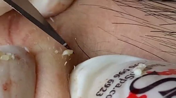 Выдавливание прыщей, угрей, черных точек и камедонов #169