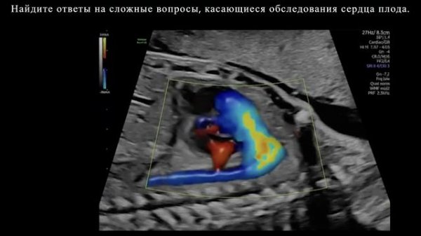 Диагноз. Передовые инструменты для уверенной диагностике на Voluson Expert 22.