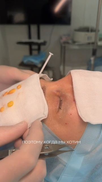 #блефаропластика с липофилингом: в чем особенности
