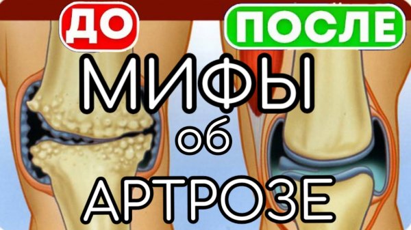 Мифы про артроз коленного сустава / Гонартроз неизлечим? Только операция? Ходьба разрушит суставы...