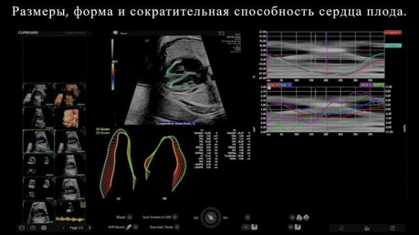Мониторинг дополнительных данных сердца плода на Voluson Expert 22.