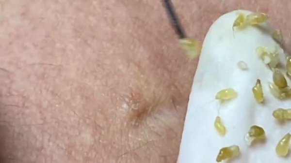 Выдавливание прыщей, угрей, черных точек и камедонов #173