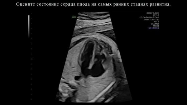 Обнаружение. Сердце плода на ультразвуковой системе Voluson Expert 22