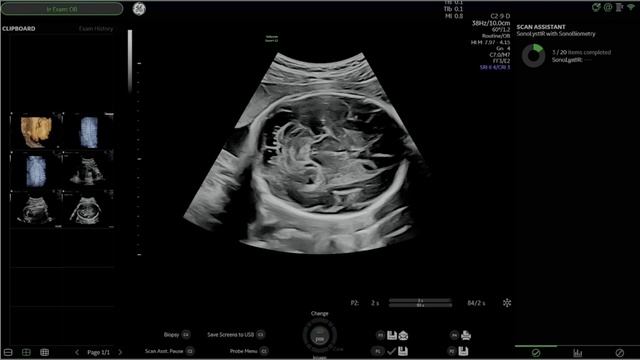 SonoLystIR автоматически определяет рекомендуемые ракурсы. смотреть онлайн