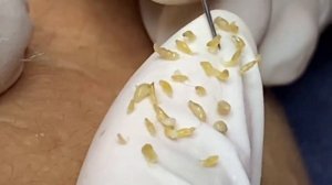 Выдавливание прыщей, угрей, черных точек и камедонов #174