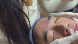 Удовольствие от выдавливания: чёрные точки и глубокие комедоны