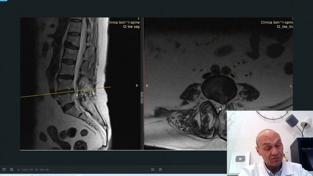 Рецидив грыжи диска
