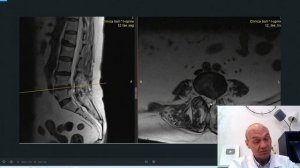 Рецидив грыжи диска