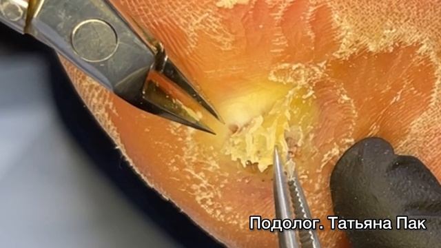 Удаление мозоли смотреть онлайн