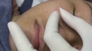 Asmr. Профессиональная чистка от прыщей и сальных пробок.