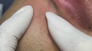 Механическая чистка лица от белых точек