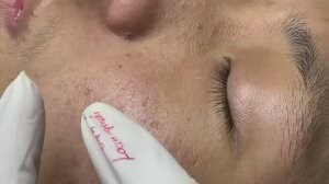 Лечение акне и пигментных пятен