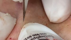 Выдавливание прыщей, угрей, черных точек и камедонов #175