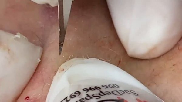 Выдавливание прыщей, угрей, черных точек и камедонов #175