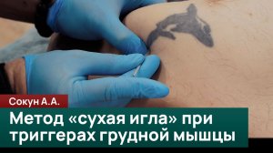 Метод «сухая игла» в работе с триггерными точками грудной мышцы. Сокун А.А.