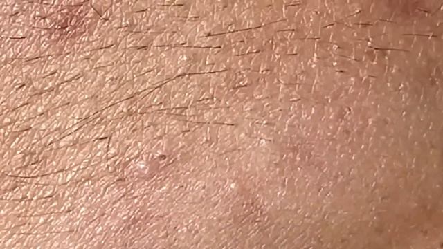 Лечение акне и прыщей. Расслабляйтесь от выдавливания! #уходзалицом #выдавливаниепрыщей смотреть онлайн