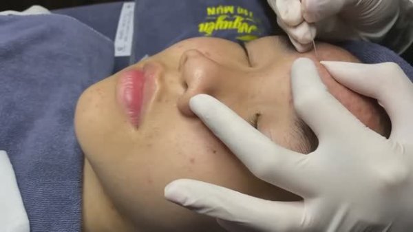 Процедура удаления прыщей в спа-салоне