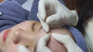 Чистая кожа без шрамов — лечение акне механическим путем