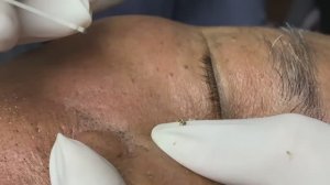 Процедура удаления прыщей в спа-салоне