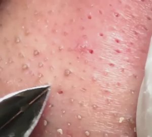 Полное очищение: часовая экстракция комедонов