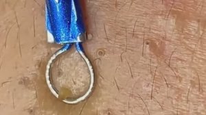 Чистка лица от угрей и акне. Выдавливание прыщей. Удаление черных точек и комедонов