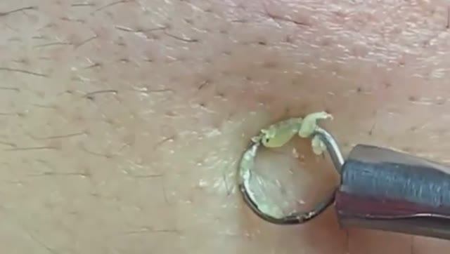 Чистка лица от угрей и акне. Выдавливание прыщей. Удаление черных точек и комедонов смотреть онлайн