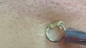 Чистка лица от угрей и акне. Выдавливание прыщей. Удаление черных точек и комедонов