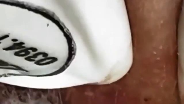 2 часа нежного удаления кистозных прыщей черных точек и комедонов