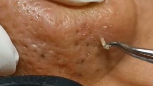 Чистка лица от угрей и акне. Выдавливание прыщей. Удаление черных точек и комедонов