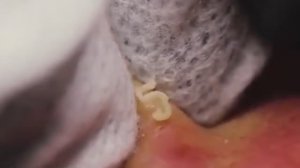 Чистка лица от угрей и акне. Выдавливание прыщей. Удаление черных точек и комедонов