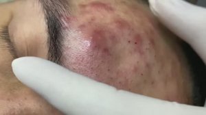 Очищение кожи от прыщей для здоровья и красоты