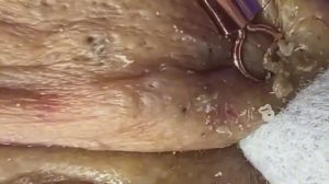 Чистка лица от угрей и акне. Выдавливание прыщей. Удаление черных точек и комедонов