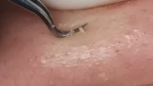 Чистка лица от угрей и акне. Выдавливание прыщей. Удаление черных точек и комедонов