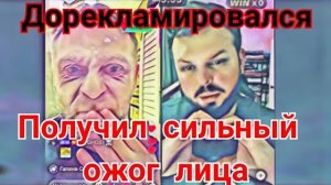 Просто поговорим - Самвел Адамян Получил сильный ожог лица Все плохо Срочно нужен кардиолог