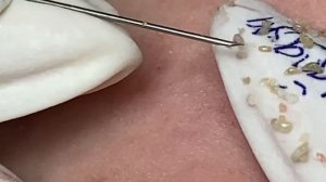 Лечение закрытых комедонов. Расслаблющее видео.