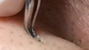 Чистка лица от угрей и акне. Выдавливание прыщей. Удаление черных точек и комедонов