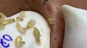 Выдавливание прыщей, угрей, черных точек и камедонов #180