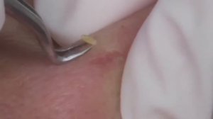 Чистка лица от угрей и акне. Выдавливание прыщей. Удаление черных точек и комедонов