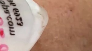 Выдавливание прыщей, угрей, черных точек и камедонов #179