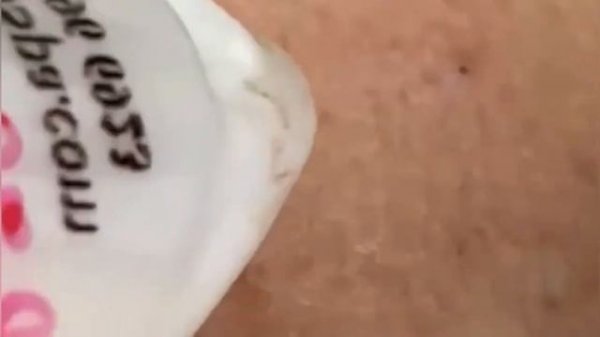 Выдавливание прыщей, угрей, черных точек и камедонов #179