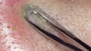 Чистка лица от угрей и акне. Выдавливание прыщей. Удаление черных точек и комедонов